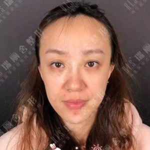 瑞麗舍整形馬君做的全臉自體脂肪填充，不錯(cuò)呢~