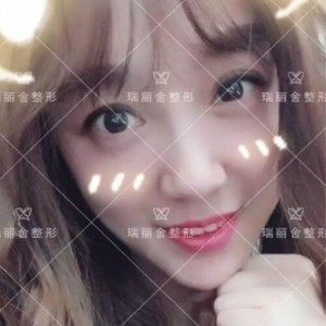 瑞麗舍整形馬君做的全臉自體脂肪填充，不錯(cuò)呢~