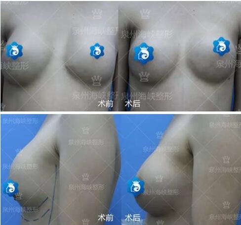 黃惠銘隆胸失敗修復案例