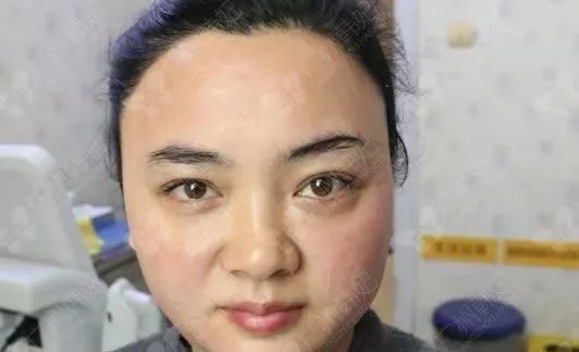 廣州韓妃美版超聲提拉和埋線提升提升日記一則，給你好看~