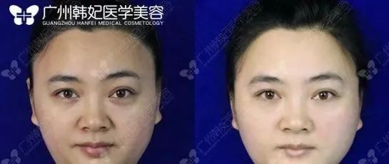 廣州韓妃美版超聲提拉和埋線提升提升日記一則，給你好看~