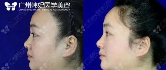 廣州韓妃美版超聲提拉和埋線提升提升日記一則，給你好看~