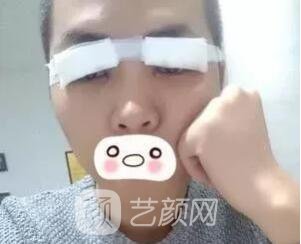 愛思特張姣姣雙眼皮案例照片日記 男生也會(huì)做雙眼皮手術(shù)哦