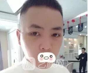 愛思特張姣姣雙眼皮案例照片日記 男生也會(huì)做雙眼皮手術(shù)哦