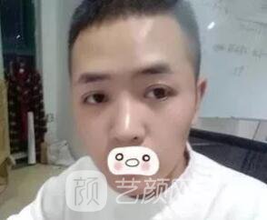 愛思特張姣姣雙眼皮案例照片日記 男生也會(huì)做雙眼皮手術(shù)哦