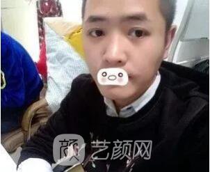 愛思特張姣姣雙眼皮案例照片日記 男生也會(huì)做雙眼皮手術(shù)哦