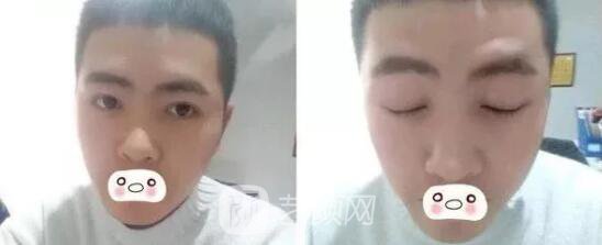 愛思特張姣姣雙眼皮案例照片日記 男生也會(huì)做雙眼皮手術(shù)哦