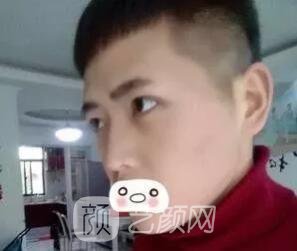 愛思特張姣姣雙眼皮案例照片日記 男生也會(huì)做雙眼皮手術(shù)哦