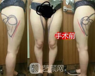 東莞締美陳星光大腿吸脂照片 內(nèi)附全部恢復(fù)過程體驗(yàn)