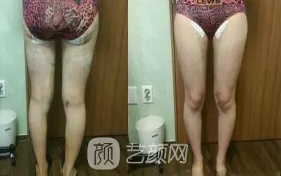 東莞締美陳星光大腿吸脂照片 內(nèi)附全部恢復(fù)過程體驗(yàn)