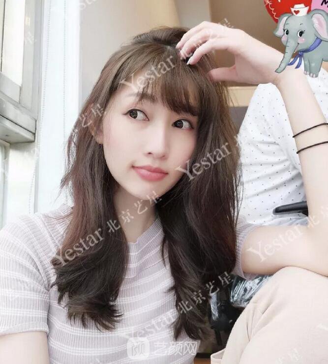 北京藝星整形醫(yī)院注射瘦臉￥499 | 打完半個(gè)月，來看看果!
