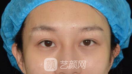 北京西美整形全切雙眼皮，徹底拯救我的大小眼