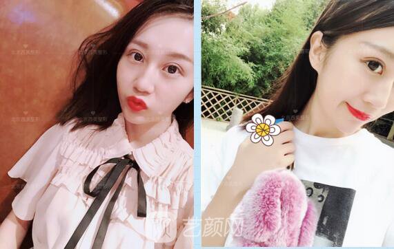北京西美整形全切雙眼皮，徹底拯救我的大小眼