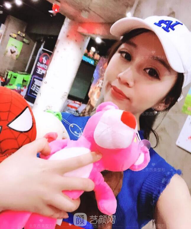 北京西美整形全切雙眼皮，徹底拯救我的大小眼