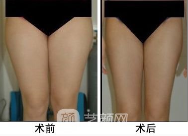 腿部曲線蛻變
