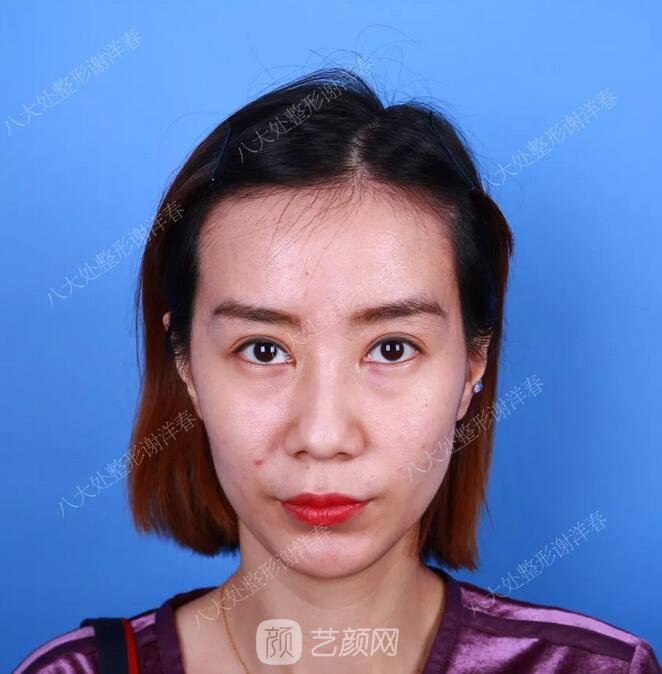 北京八大處面部脂肪填充心形臉真實案例|照片