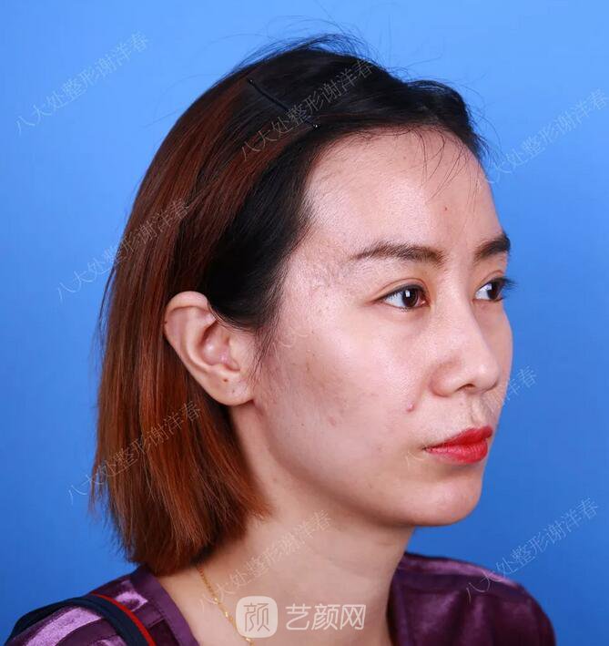 北京八大處面部脂肪填充心形臉真實案例|照片