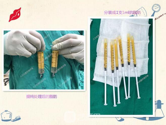 北京八大處面部脂肪填充心形臉真實案例|照片