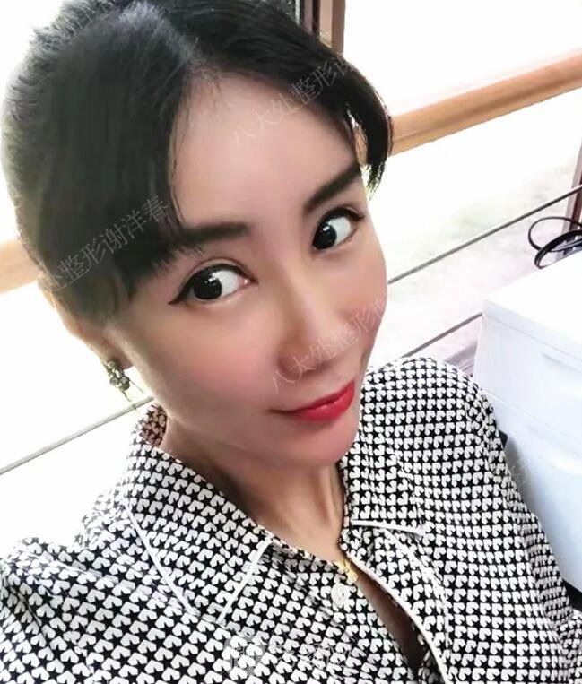 北京八大處面部脂肪填充心形臉真實案例|照片