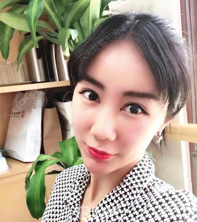 北京八大處面部脂肪填充心形臉真實案例|照片