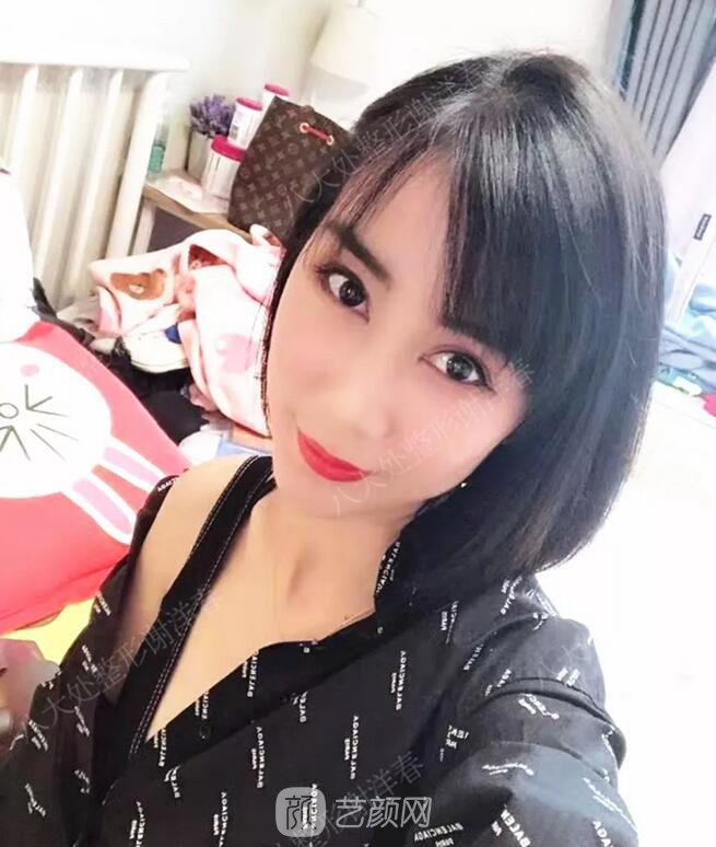 北京八大處面部脂肪填充心形臉真實案例|照片
