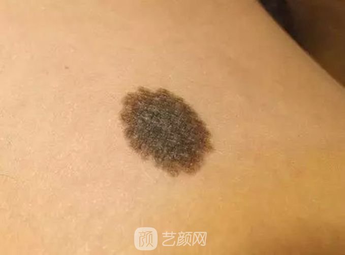北京激光去痦子多少錢(qián)？
