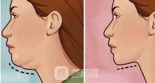 深圳磨尖下巴骨多少錢？