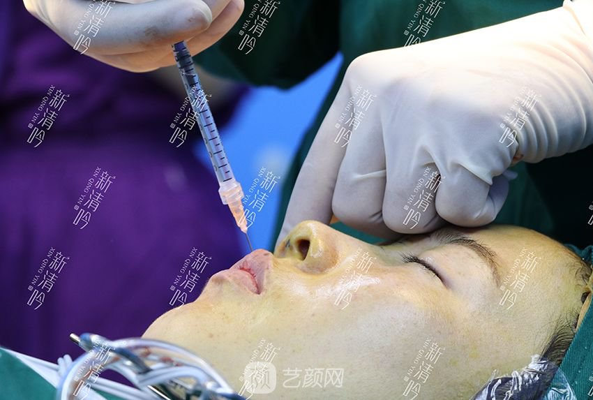 耳軟骨隆鼻果圖分享，術(shù)后~