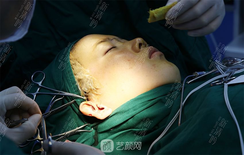 耳軟骨隆鼻果圖分享，術(shù)后~