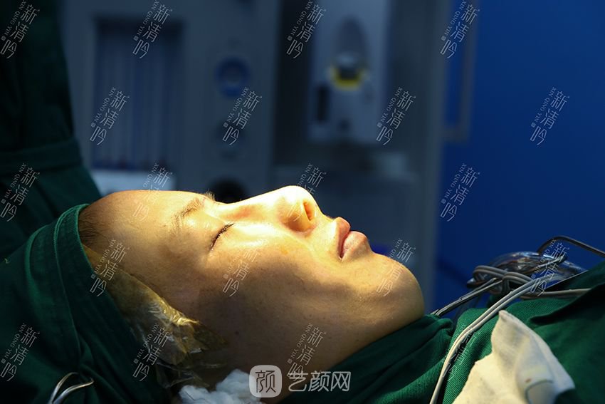 耳軟骨隆鼻果圖分享，術(shù)后~