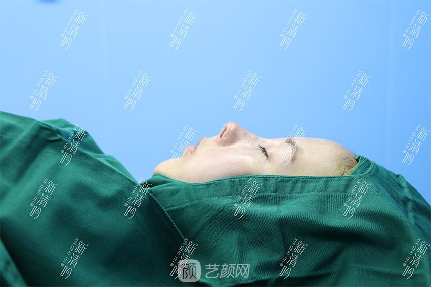 耳軟骨隆鼻果圖分享，術(shù)后~