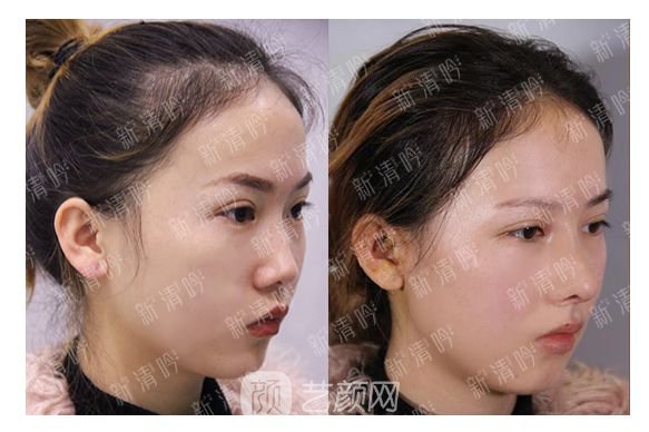 耳軟骨綜合隆鼻半個(gè)月了，分享恢復(fù)果照片~