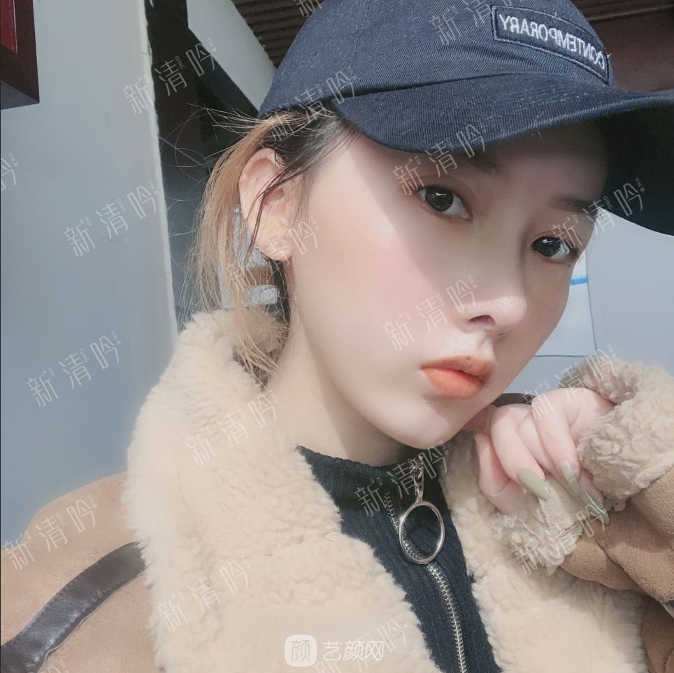 耳軟骨綜合隆鼻半個(gè)月了，分享恢復(fù)果照片~