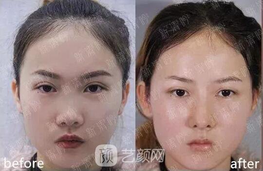 耳軟骨隆鼻果怎么樣？案例照片一覽~