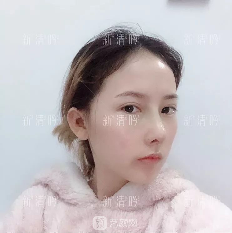 耳軟骨隆鼻果怎么樣？案例照片一覽~