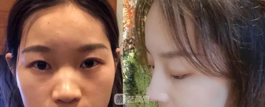 鼻部手術(shù)一個(gè)月恢復(fù)日記分享~