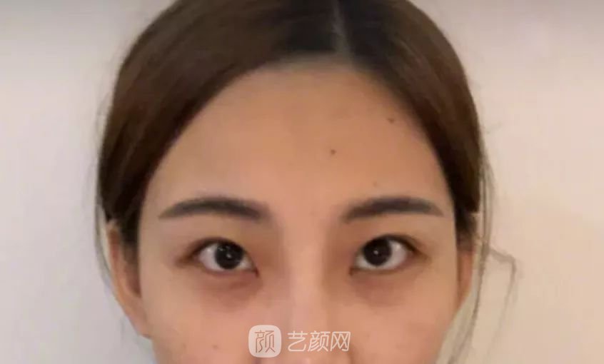 眼部手術(shù)一個月恢復(fù)日記，片分享~