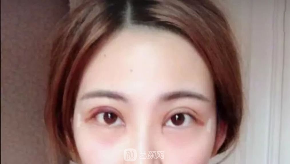 眼部手術(shù)一個月恢復(fù)日記，片分享~