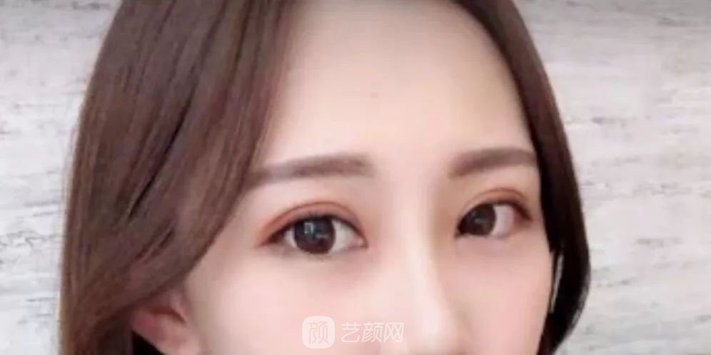 眼部手術(shù)一個月恢復(fù)日記，片分享~