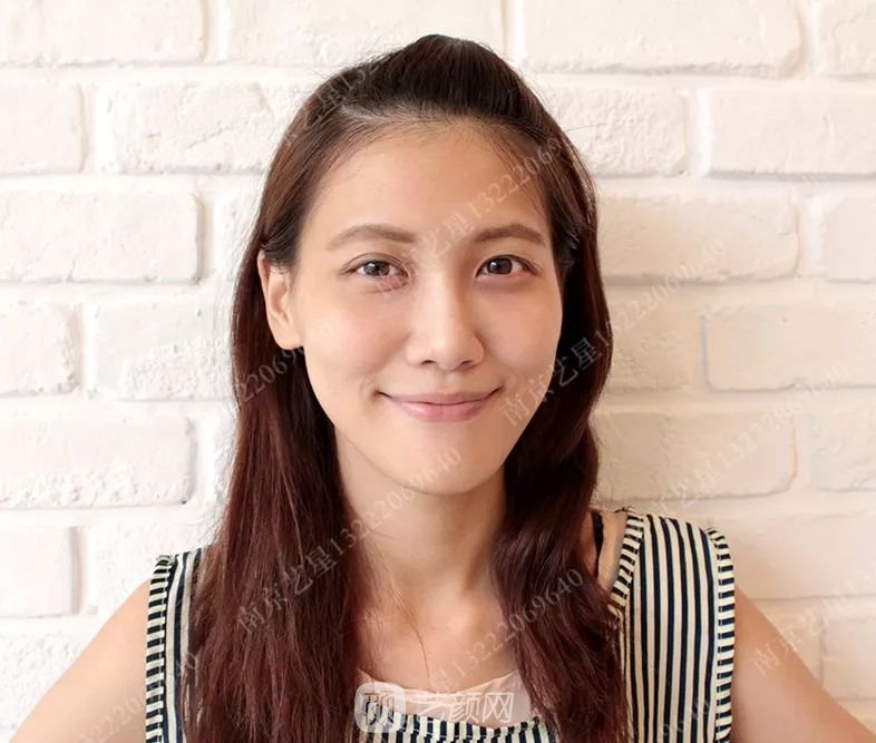 Yestar美杜莎美眼術(shù)一周案例圖片，芭比雙眼皮果很好~