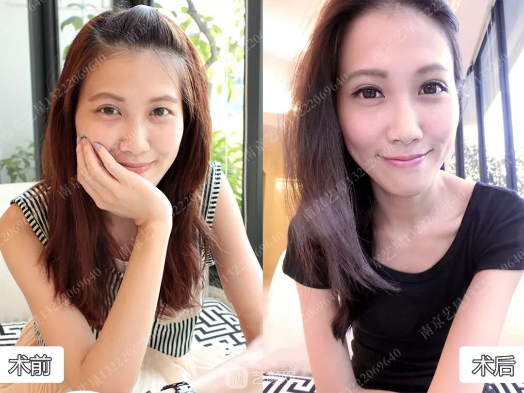 Yestar美杜莎美眼術(shù)一周案例圖片，芭比雙眼皮果很好~