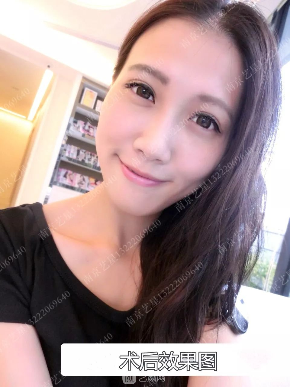 Yestar美杜莎美眼術(shù)一周案例圖片，芭比雙眼皮果很好~