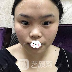 成都美容整形醫(yī)院馮春雨硅膠隆鼻+假體墊下巴案例