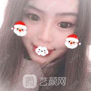 四川隆鼻哪家醫(yī)院好？成都成美馮春雨硅膠隆鼻+假體墊下巴恢復(fù)果圖