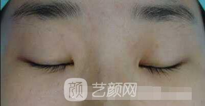 張嬌嬌醫(yī)生做的小切口雙眼皮手術案例