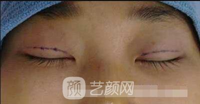 張嬌嬌醫(yī)生做的小切口雙眼皮手術案例