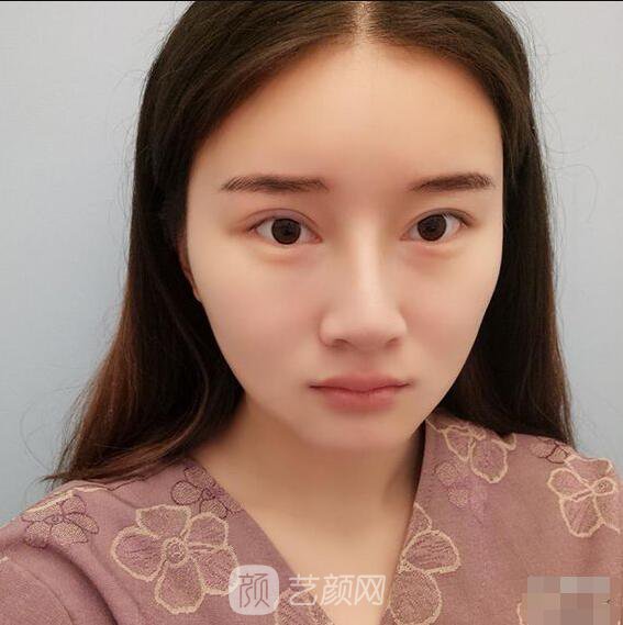 顴骨內(nèi)推真實(shí)案例，小臉網(wǎng)紅模板臉型