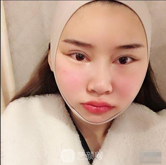 顴骨內(nèi)推真實(shí)案例，小臉網(wǎng)紅模板臉型