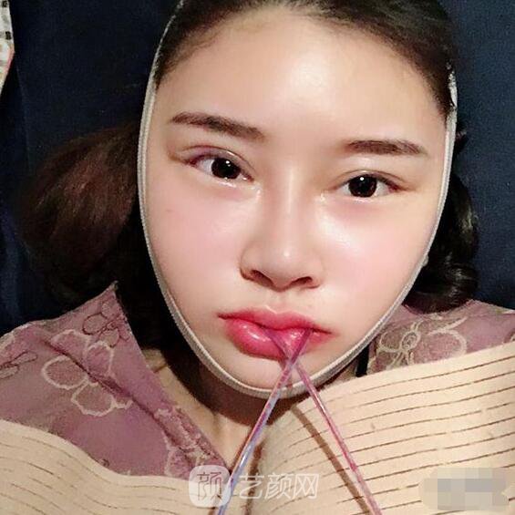顴骨內(nèi)推真實(shí)案例，小臉網(wǎng)紅模板臉型