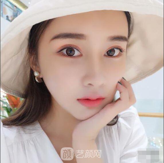顴骨內(nèi)推真實(shí)案例，小臉網(wǎng)紅模板臉型